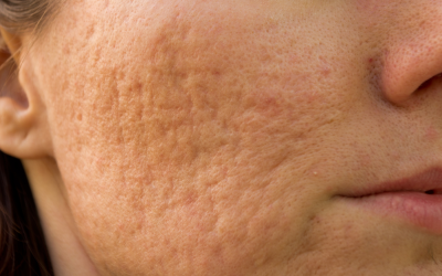 How Does Acne Scar Treatment Work?