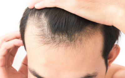 Experiencing Hair Loss? Consider Hair Restoration Treatments