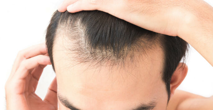 Experiencing Hair Loss? Consider Hair Restoration Treatments