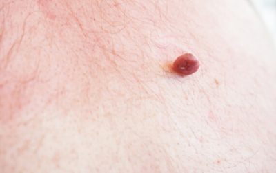 How to Remove Skin Tags