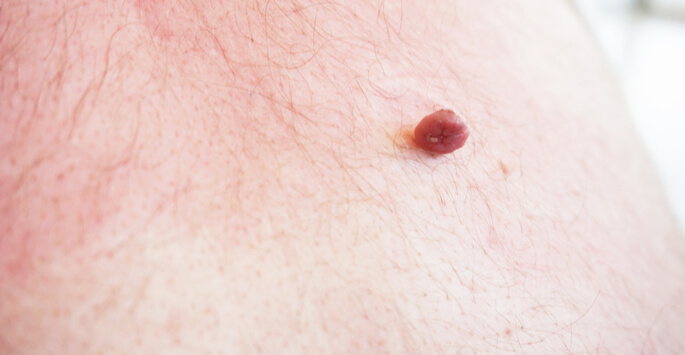 How to Remove Skin Tags