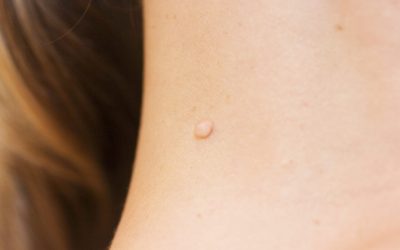 Skin Tag Removals: How Does It Work? Why you should visit professional?