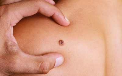 What Should You Expect From Mole Removal Treatment?