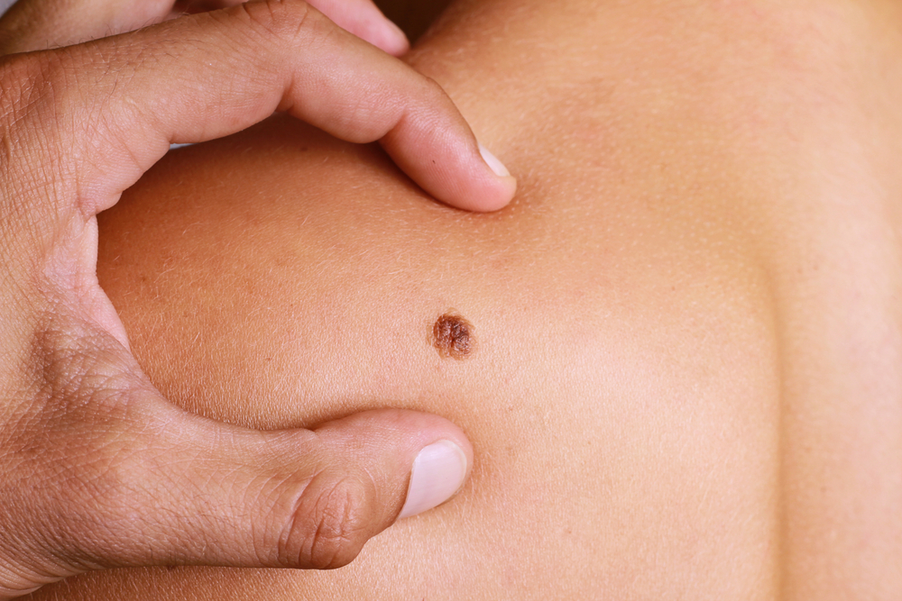 What Should You Expect From Mole Removal Treatment?