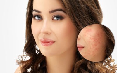 Look Your Best with Acne Scar Treatment