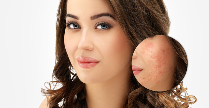 Look Your Best with Acne Scar Treatment