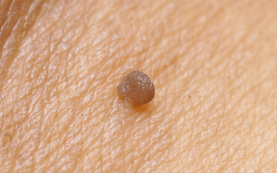 The Key Benefits of Skin Tag Removal