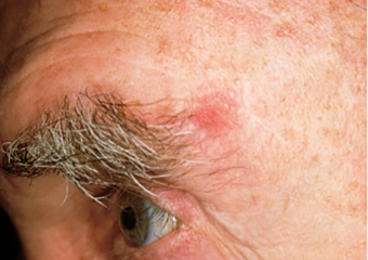 A basal cell carcinoma may be pigmented on skin of color, near the eye