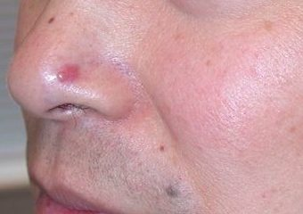 Basal cell carcinoma on the nose